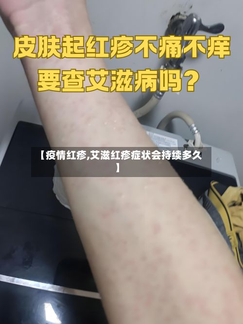 【疫情红疹,艾滋红疹症状会持续多久】-第2张图片