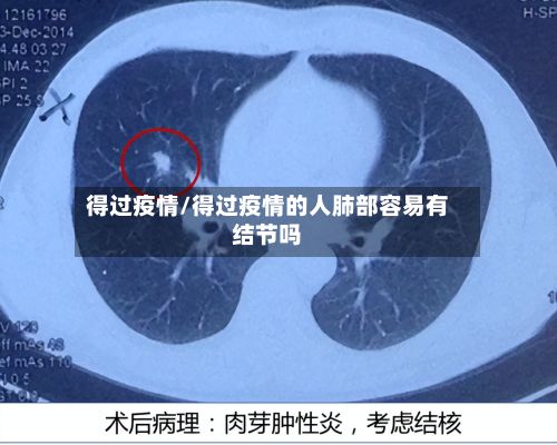 得过疫情/得过疫情的人肺部容易有结节吗-第3张图片